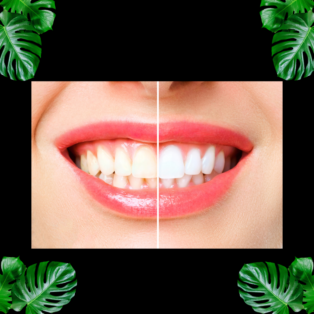 1 Hour Extreme ‘Naturawhite’ Laser Teeth Whitening (Protaras)